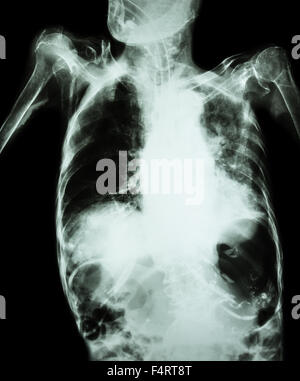 La tuberculose pulmonaire avec insuffisance respiratoire aiguë ( Film radiographie pulmonaire de l'ancien show patient interstitielle et alvéolaire infiltrat Banque D'Images