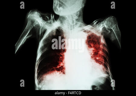 La tuberculose pulmonaire avec insuffisance respiratoire aiguë ( Film radiographie pulmonaire de l'ancien show patient interstitielle et alvéolaire infiltrat Banque D'Images