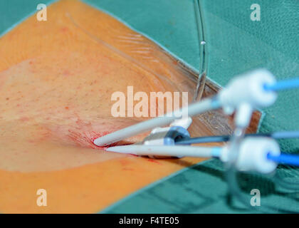 Procédure d'ablation par cathéter au Centre clinique universitaire Sister of Mercy à Zagreb, Croatie Banque D'Images