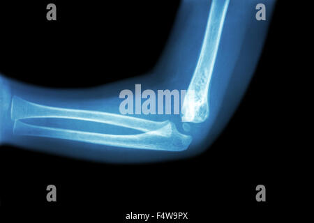 Film x-ray de l'enfant ( coude coude de l'enfant normal ) ( vue latérale latérale , ) Banque D'Images