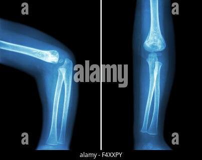 Film x-ray de l'enfant ( coude coude de l'enfant normal ( ) et à l'avant et latérale , vue antérieure - vue postérieure ) ( 2 positions Banque D'Images