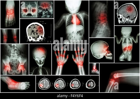 X-ray plusieurs partie de l' enfant corps & maladies multiples ( cp , tumeur au cerveau , l'arthrite rhumatoïde, sinusite , goutteux arthri Banque D'Images