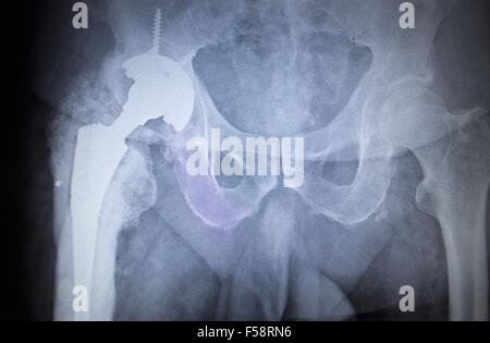 X-ray image scan de joints de hanche squelette humain en bleu gris. Numérisé en orthopédie traumatologie Hôpital clinique de chirurgie. Banque D'Images