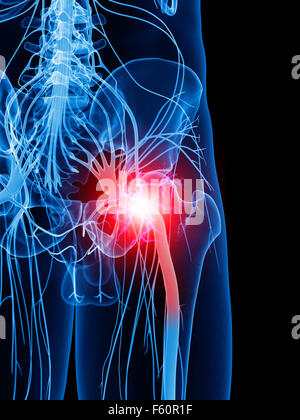 Illustration d'une précision médicale nerf sciatique douloureux Banque D'Images