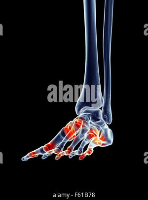 Illustration - médicalement exacts des articulations du pied douloureux Banque D'Images