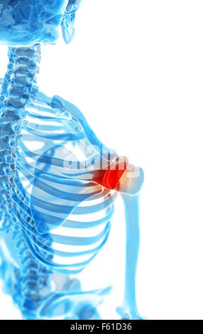 Illustration - médicalement exacts de l'épaule douloureuse Banque D'Images