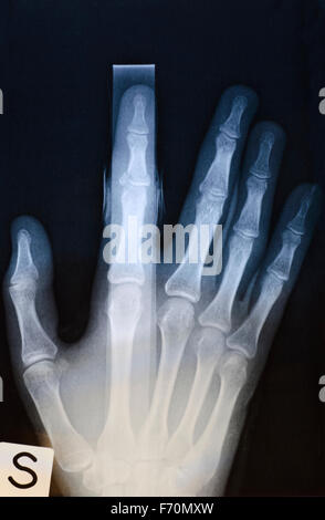 X-ray image de main humaine avec stick de fractures Banque D'Images