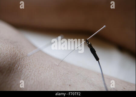 Electro acupuncture appliquée avec des aiguilles pour les patients de la jambe, Banque D'Images