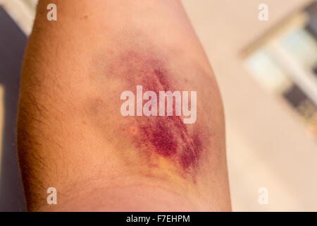 Libre d'un grand rouge et mauve bleu sur un avant-bras et du bras intérieur mans Banque D'Images