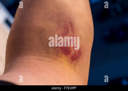 Libre d'un grand rouge et mauve bleu sur un avant-bras et du bras intérieur mans Banque D'Images