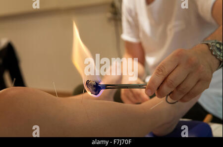 Reportage sur un thérapeute qui se spécialise dans la médecine traditionnelle chinoise. Le thérapeute combine les aiguilles et la moxibustion, chauffage les aiguilles aux points d'acupuncture permet d'être stimulé plus Banque D'Images