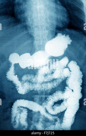 L'INTESTIN, X-RAY Banque D'Images