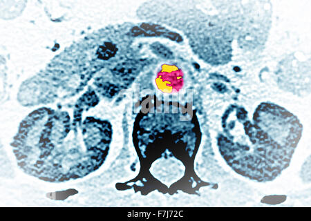 La calcification ARTÉRIELLE CT SCAN Banque D'Images