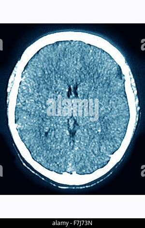 L'ŒDÈME CÉRÉBRAL CT SCAN Banque D'Images