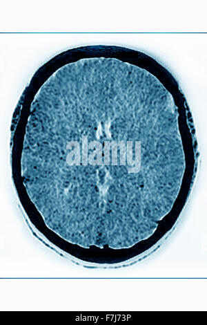 L'ŒDÈME CÉRÉBRAL CT SCAN Banque D'Images