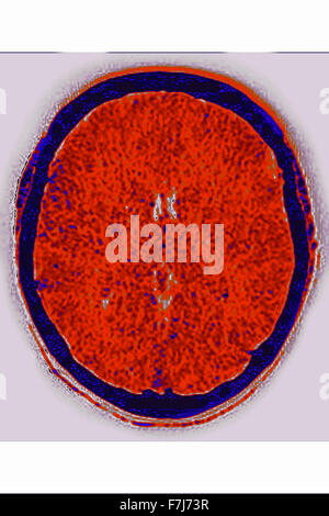 L'ŒDÈME CÉRÉBRAL CT SCAN Banque D'Images