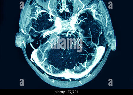 Thrombose veineuse cérébrale Banque D'Images