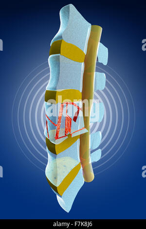 Colonne vertébrale, moelle osseuse, les fractures vertébrales traumatiques, burst fracture. La section de la colonne vertébrale Banque D'Images