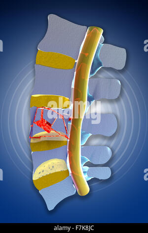 Colonne vertébrale, moelle osseuse, les fractures vertébrales traumatiques, burst fracture. La section de la colonne vertébrale Banque D'Images