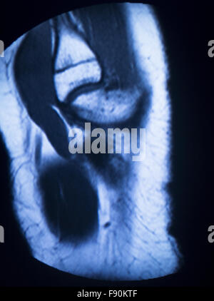 L'imagerie par résonance magnétique IRM scanner médical résultats de tests prouvant l'articulation du genou, ménisque, fémur, cuisse et mollet de la jambe, les ligaments, Banque D'Images