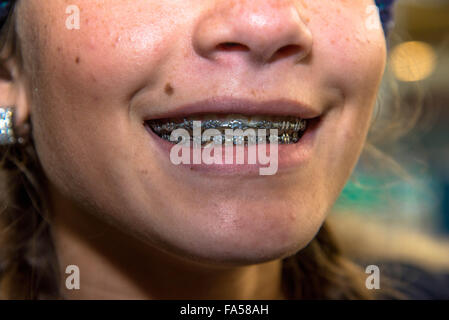 Fille avec des pièces en métal sur les dents pour la correction Banque D'Images