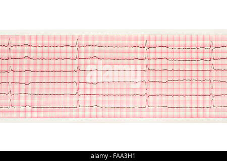 Les résultats de l'ECG papier isolé sur fond blanc. Chemin de détourage inclus. Banque D'Images