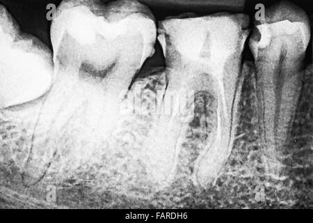 L'obturation du canal radiculaire des dents sur les systèmes X-Ray Banque D'Images