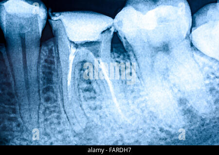 L'obturation du canal radiculaire des dents sur les systèmes X-Ray Banque D'Images