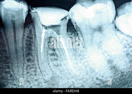 L'obturation du canal radiculaire des dents sur les systèmes X-Ray Banque D'Images