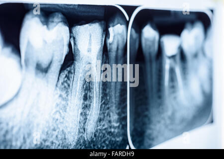 L'obturation du canal radiculaire des dents sur les systèmes X-Ray Banque D'Images