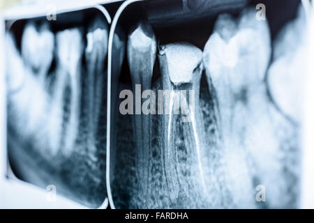 L'obturation du canal radiculaire des dents sur les systèmes X-Ray Banque D'Images