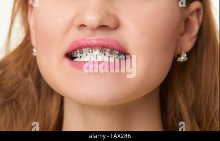 Bagues sur les dents, belle femme sourire face close up. Banque D'Images