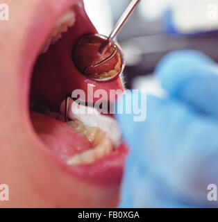 Le dentiste examine la bouche du patient, Close up Banque D'Images