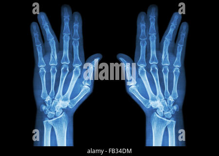 L'arbre de la fracture de l'annulaire de la phalange proximale ( film x-ray mains deux AP ) Banque D'Images