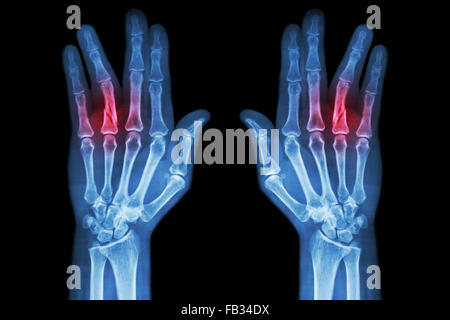 L'arbre de la fracture de l'annulaire de la phalange proximale ( film x-ray mains deux AP ) Banque D'Images