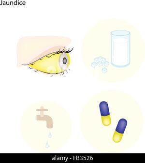 Concept médical, Illustration de l'ictère causé par une augmentation de la bilirubine dans le sang. Illustration de Vecteur