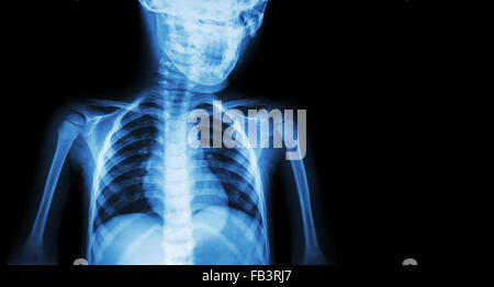 Film x-ray corps d'enfant et la zone vide du côté droit ( Médecine ) Banque D'Images