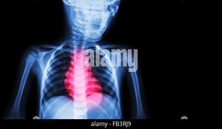 La maladie cardiaque ischémique , Infarctus du myocarde ( MI ) ( Film x-ray de corps humain avec la maladie cardiaque et la zone vide du côté droit Banque D'Images