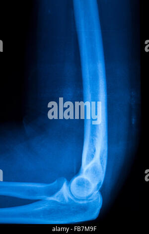 Othopedics et traumatologie implant chirurgical et le coude du bras de xray test d'acquisition des résultats montrant la plaque de métal et des vis en titane. Banque D'Images