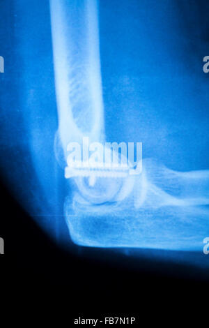 Othopedics et traumatologie implant chirurgical et le coude du bras de xray test d'acquisition des résultats montrant la plaque de métal et des vis en titane. Banque D'Images