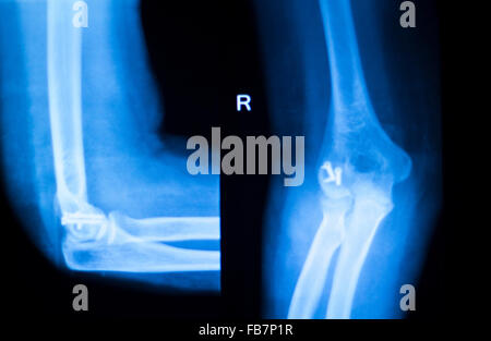 Othopedics et traumatologie implant chirurgical et le coude du bras de xray test d'acquisition des résultats montrant la plaque de métal et des vis en titane. Banque D'Images