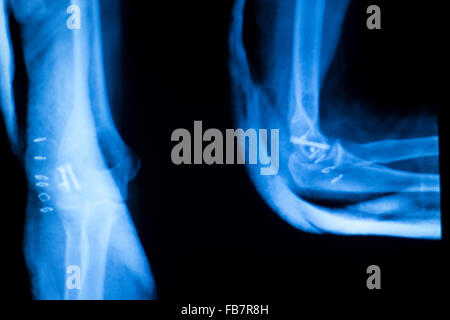 Othopedics et traumatologie implant chirurgical et le coude du bras de xray test d'acquisition des résultats montrant la plaque de métal et des vis en titane. Banque D'Images