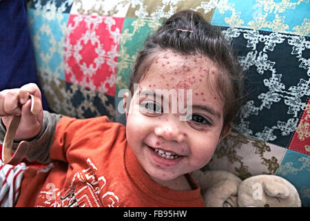 Mixed Race jeune fille avec la varicelle sourires sur le canapé Banque D'Images