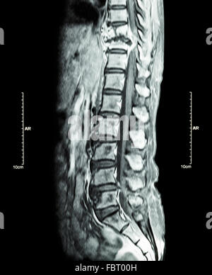 La métastase rachis ( cancer s'est propagé à colonne thoracique ) ( IRM du rachis thoracique et lombaire : voir colonne thoracique métastase et com Banque D'Images