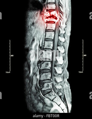 La métastase rachis ( cancer s'est propagé à colonne thoracique ) ( IRM du rachis thoracique et lombaire : voir colonne thoracique métastase et com Banque D'Images