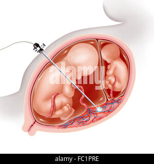 TWIN-TO-TWIN TRANSFUSION FOETAL Banque D'Images