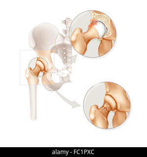 PATHOLOGIE DE HANCHE Banque D'Images