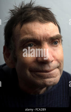 Homme avec des problèmes de santé de métal vivant avec un cancer de la gorge inopérable Banque D'Images