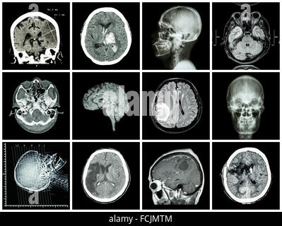 Collection de maladies du cerveau ( CT scan et irm de cerveau : afficher d'infarctus cérébral , l'hémorragie intracérébrale , tumeur au cerveau basal , Banque D'Images