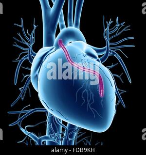Un pontage cardiaque. Illustration d'ordinateur d'un coeur qui a eu un blocage des artères coronaires traitée par pontage aortocoronarien par greffe (PACG). Les artères coronaires sont les petits vaisseaux sanguins vu courir sur la surface externe du cœur. Ils fournissent le sang oxygéné pour garder le muscle cardiaque, de pompage et d'un blocage peut entraîner une crise cardiaque mortelle. La solution est de récolter les artères des ailleurs dans le corps et les utiliser pour contourner le blocage. Un greffon est vu en cours d'exécution à partir de l'aorte, l'artère principale, retour à des artères coronaires. Banque D'Images